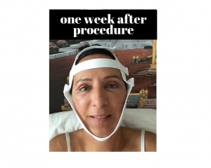 Before Procedure (4)
