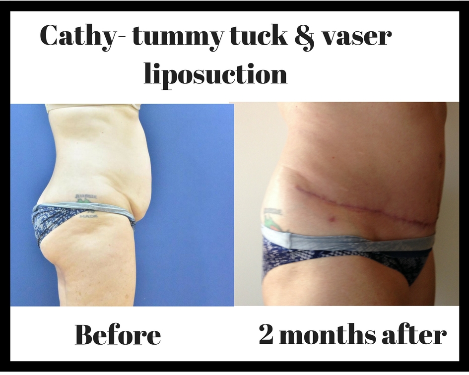 Cathy- tummy tuck & vaser liposuction