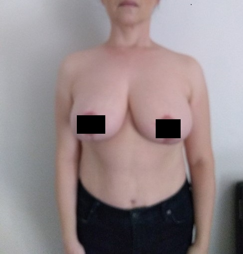Breast reduction lift - After