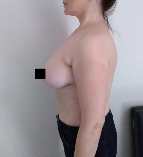 breast reduction lift - side after