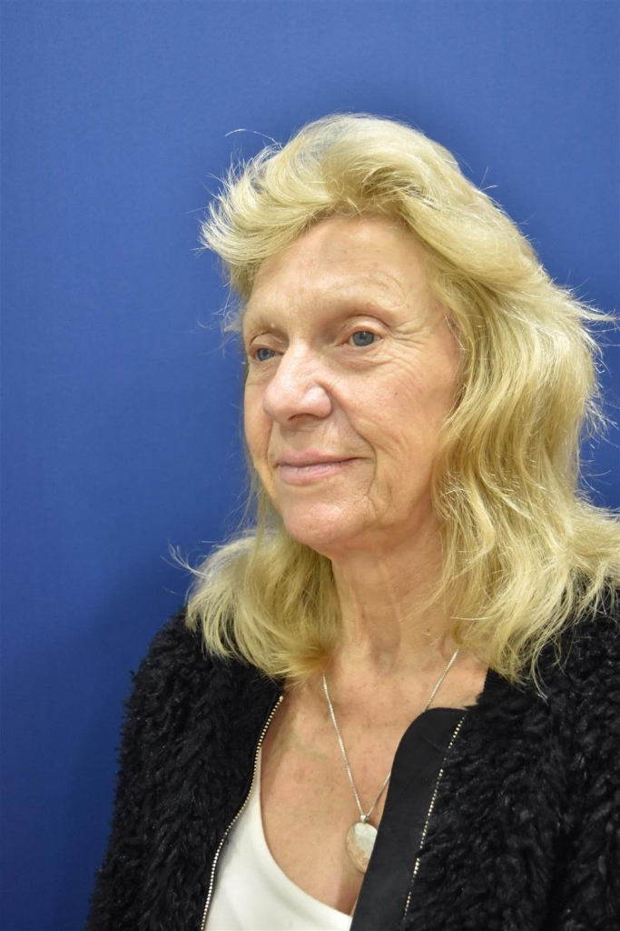 Lois_Brooks_before (1)