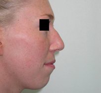 Nose Reshaping (Reduction Rhinoplasty) Nose Reshaping (Reduction Rhinoplasty)