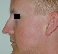 Nose Reshaping (Reduction Rhinoplasty)