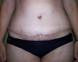 After Breast Augmentation After Breast Augmentation