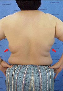 Back and Thigh Lipo Back and Thigh Lipo