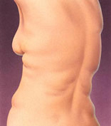 Liposuction Liposuction