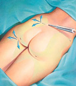 Liposuction Liposuction