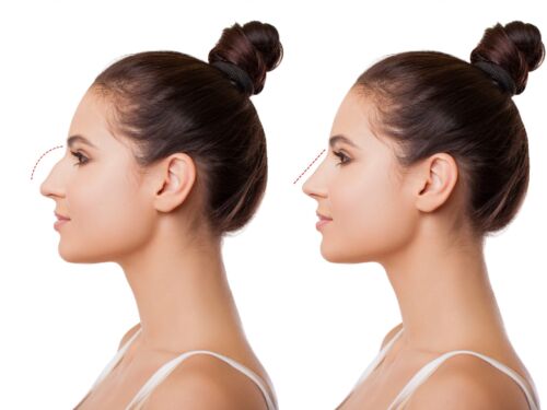 All About Rhinoplasty and Nose Shaping - Are You a Good Candidate?