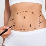 Tummy Tuck with Extended (Abdominoplasty)-(YANH)