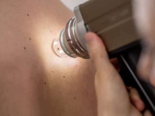 Mole excision (Excluding Pathology) - (RTC)