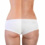 Post bariatric Body Contouring - (CMA)