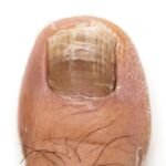 Rams Horn Nails (Onychogryphosis)-(ICR) Rams Horn Nails (Onychogryphosis)-(ICR)