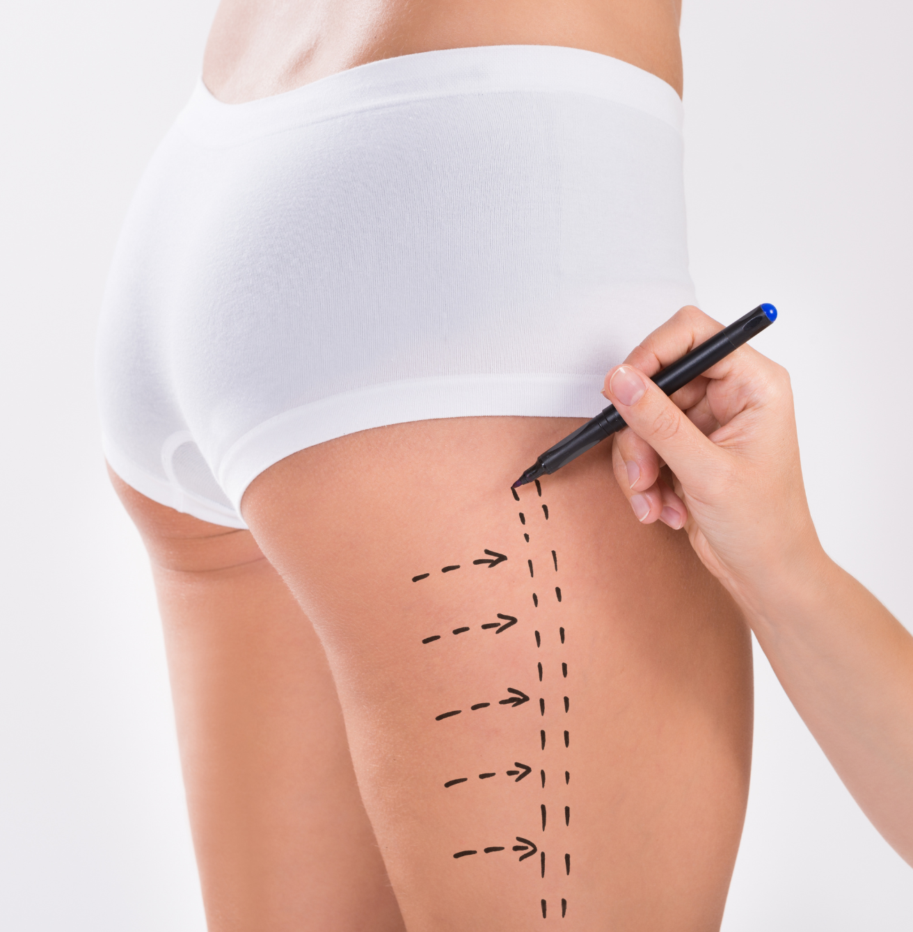 Liposuction