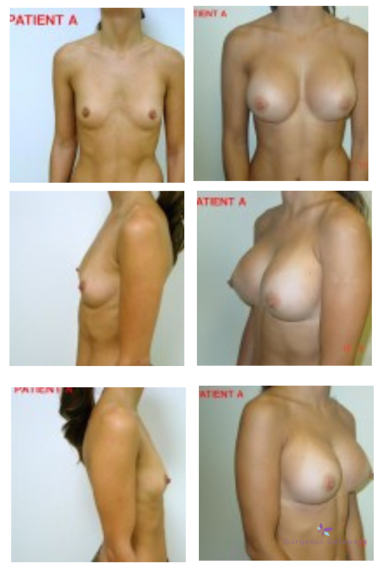 Velasco breasts